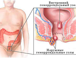 Геморроидальные узлы: что это и как вылечить?
